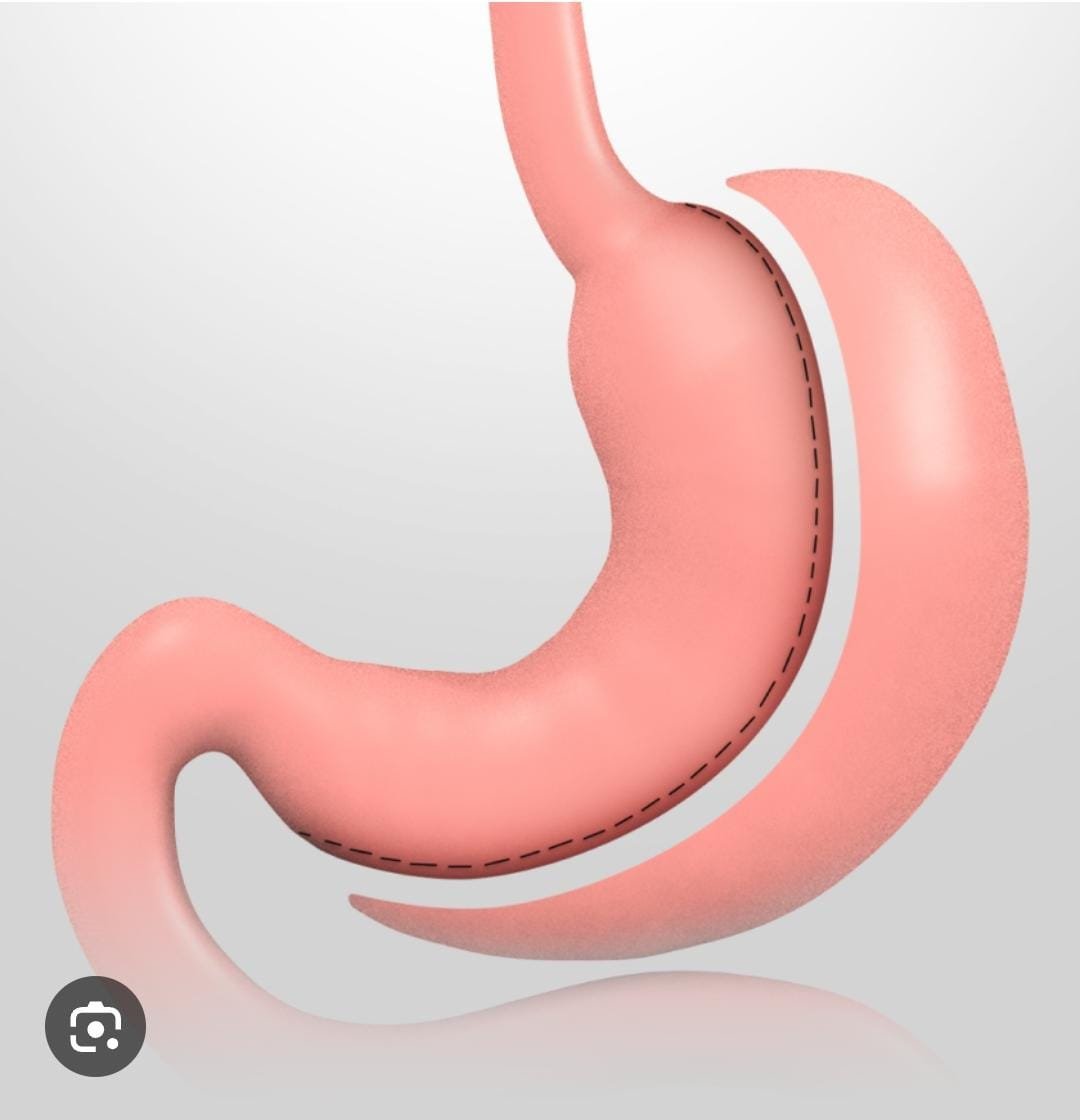 Manga Gástrica